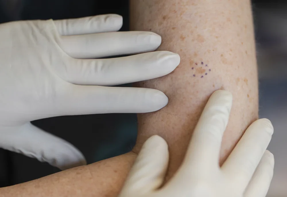 Dermatologist examining a mole during a skin cancer screening